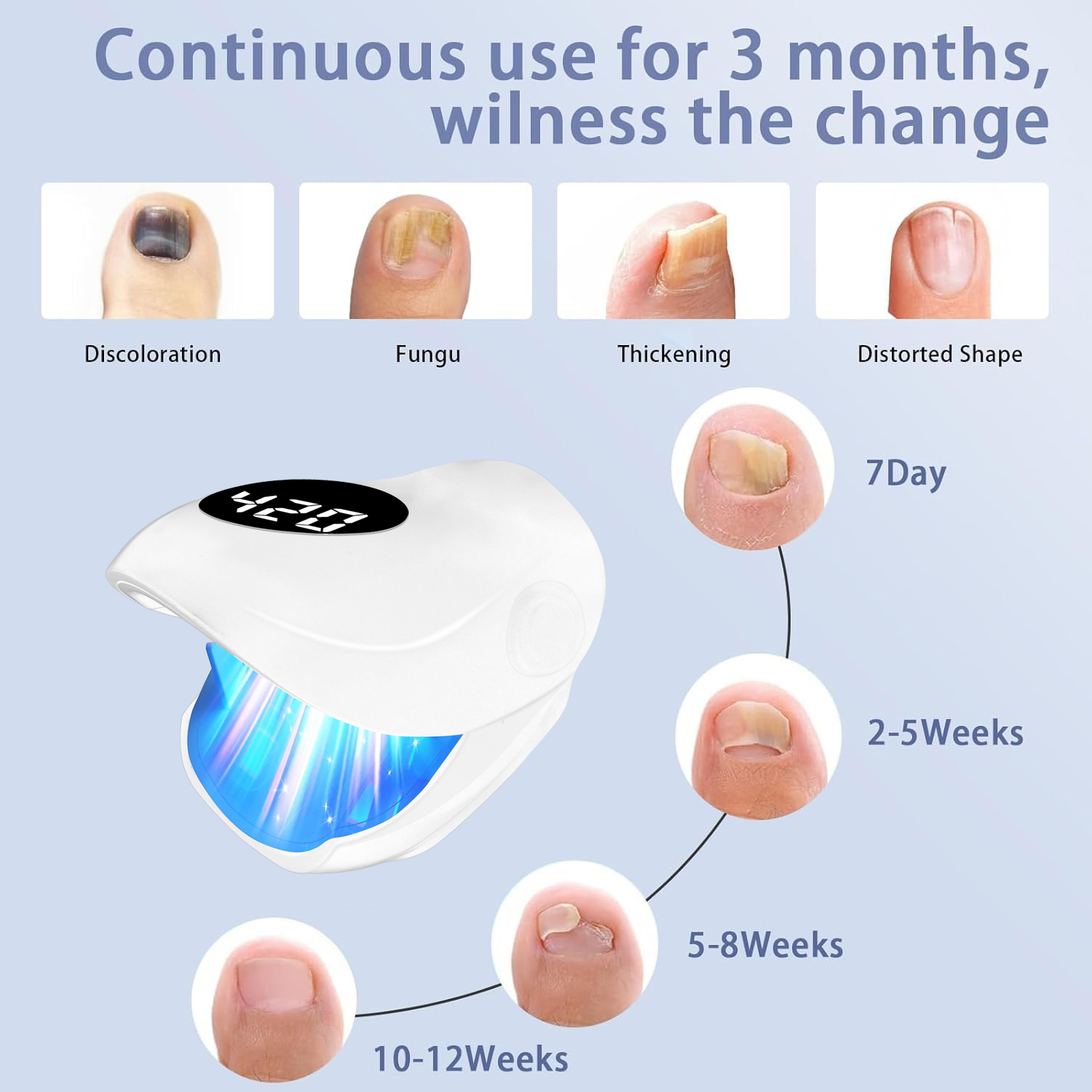 USB Charging Nail Fungus Treat - Galvanic Skin Sensor 评论和价格